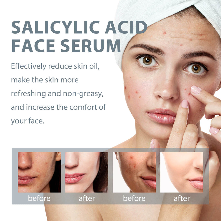 Salicylic Acid Blemish Serum – Clarifies Pores & Fades Acne Marks, 30ml
