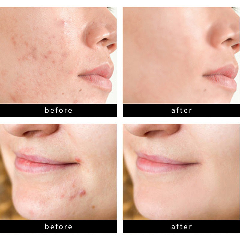 Overnight Pimple Patches – Shrink Zits & Whiteheads While You Sleep, 72 Count