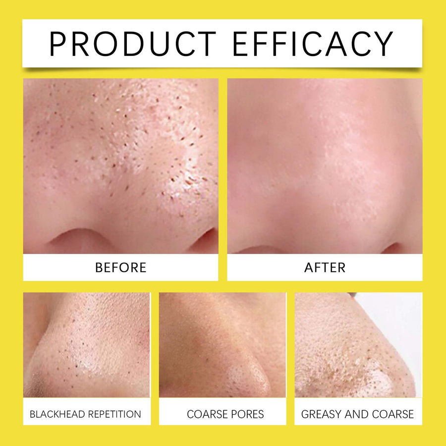 Hydrocolloid Nose Pore Patches – Absorb Blackheads & Conceal Breakouts