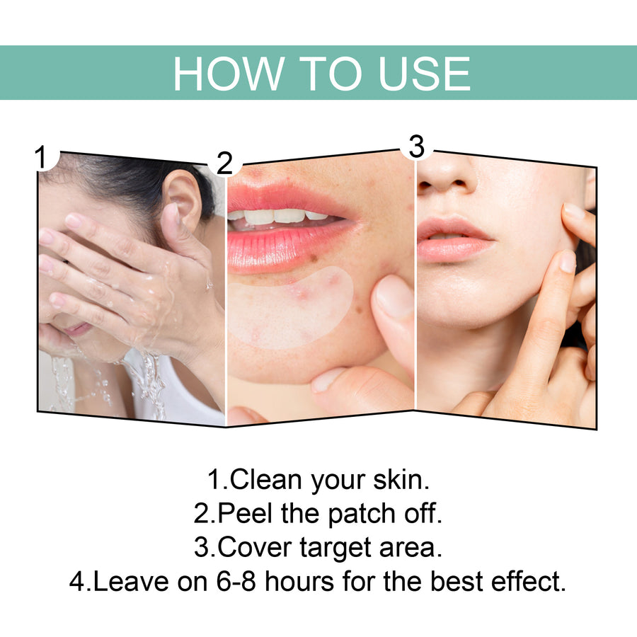 Soothing Acne Relief Patches – Gentle Spot Care That Fades Blemish Marks